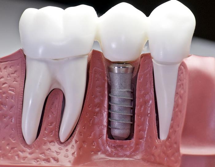 implantace zubů je